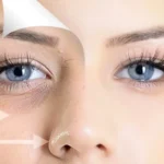 تفاوت تیرگی و گودی زیر چشم