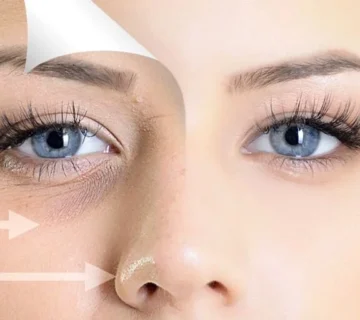 تفاوت تیرگی و گودی زیر چشم