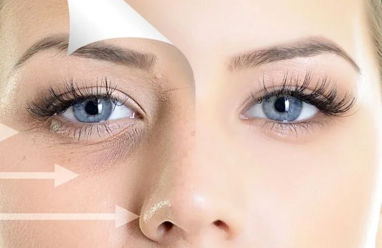 تفاوت تیرگی و گودی زیر چشم