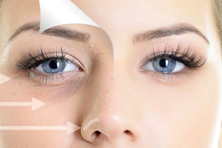تفاوت تیرگی و گودی زیر چشم